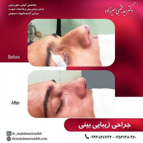 جراحی-بینی-یزد112