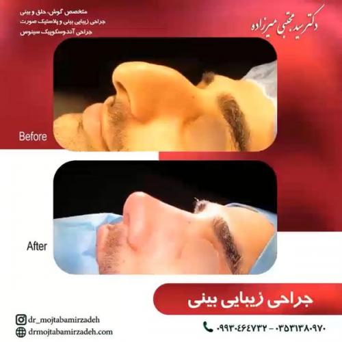 جراحی-بینی-یزد114
