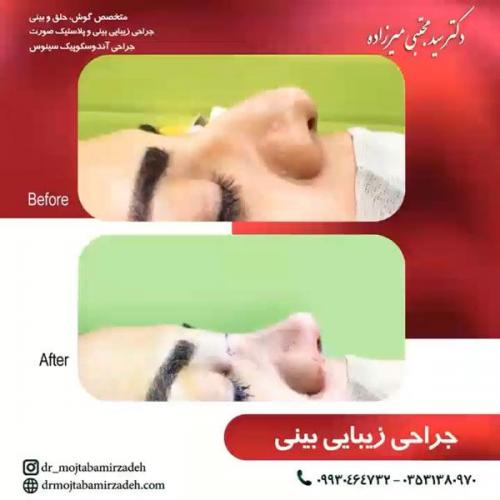 جراحی-بینی-یزد115