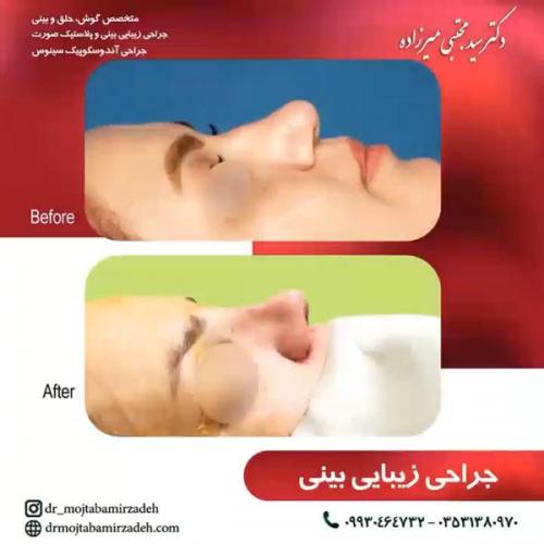 جراحی-بینی-یزد117