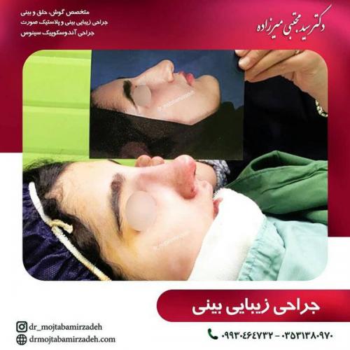 جراحی-بینی-یزد119