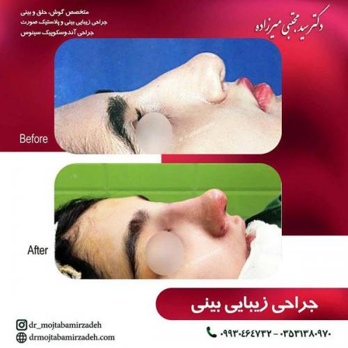 جراحی-بینی-یزد120