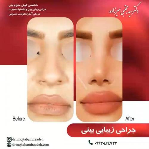 جراحی-بینی-یزد121