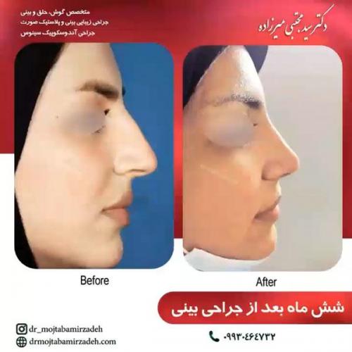 جراحی-بینی-یزد122