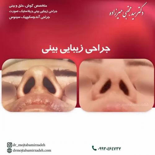 جراحی-بینی-یزد140