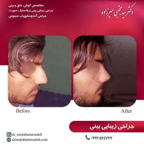 جراحی-بینی-یزد153