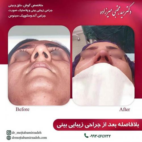 جراحی-بینی-یزد163