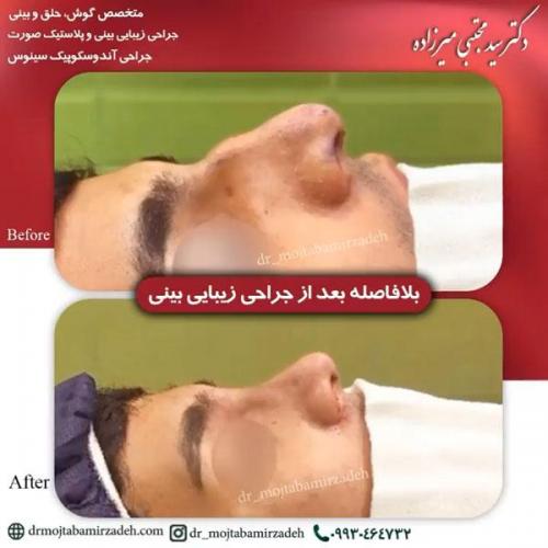 جراحی-بینی-یزد171