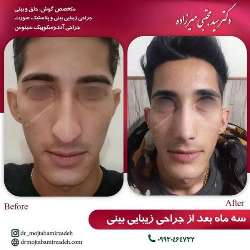 جراحی-بینی-یزد174