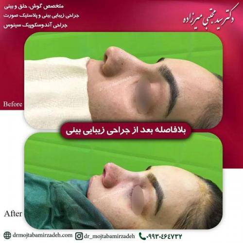 جراحی-بینی-یزد176