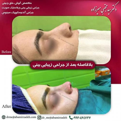 جراحی-بینی-یزد177
