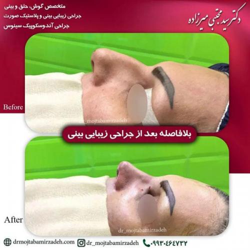 جراحی-بینی-یزد181