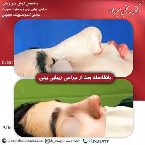 جراحی-بینی-یزد182