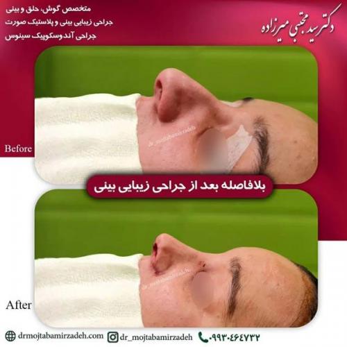 جراحی-بینی-یزد194