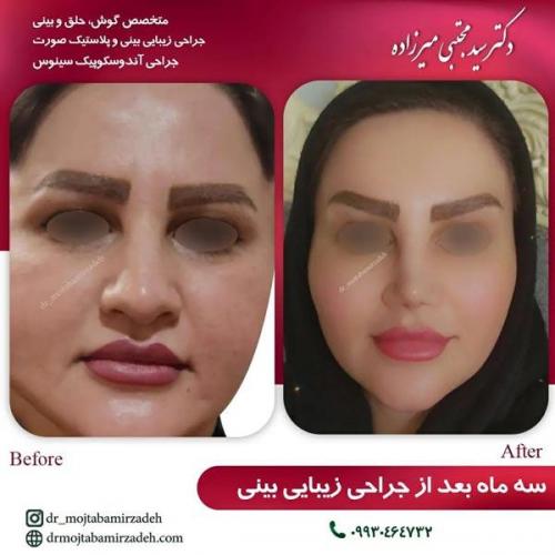 جراحی-بینی-یزد200