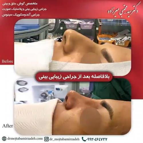 جراحی-بینی-یزد201