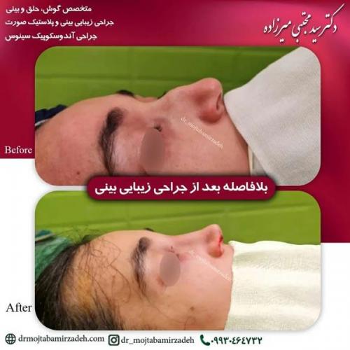 جراحی-بینی-یزد203