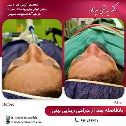 جراحی-بینی-یزد206
