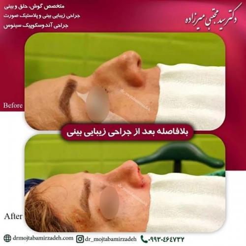 جراحی-بینی-یزد208