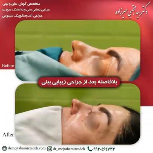 جراحی-بینی-یزد209