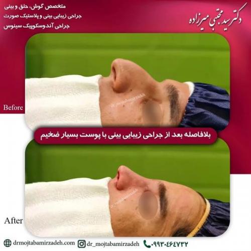 جراحی-بینی-یزد210