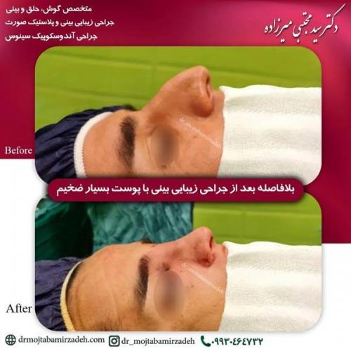 جراحی-بینی-یزد211