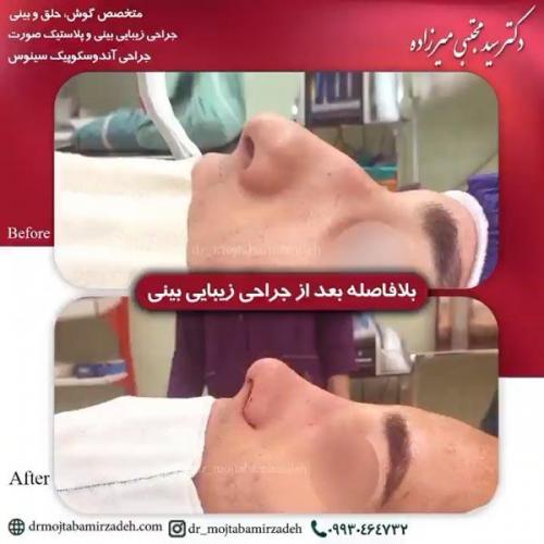 جراحی-بینی-یزد214