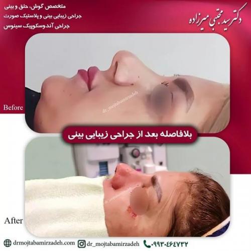 جراحی-بینی-یزد215