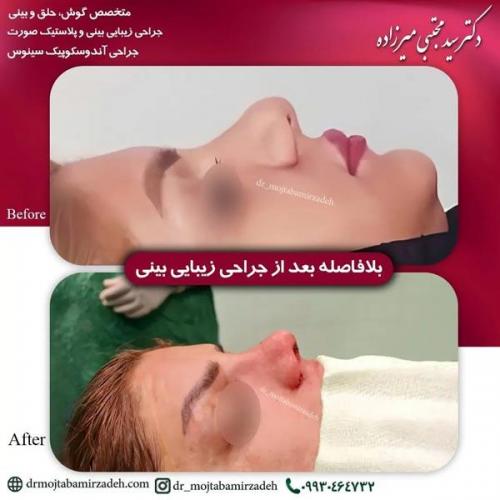 جراحی-بینی-یزد216
