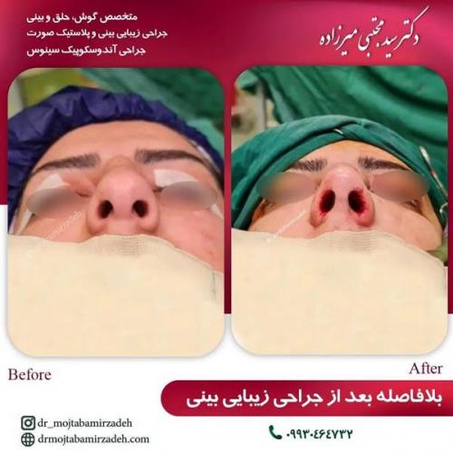 جراحی-بینی-یزد225