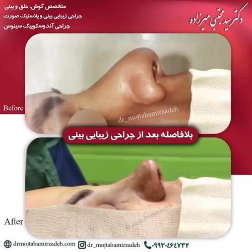 جراحی-بینی-یزد228