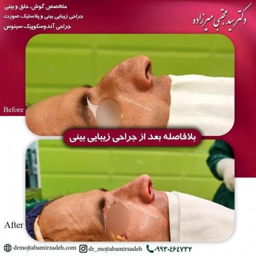 جراحی-بینی-یزد230