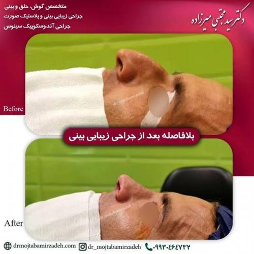 جراحی-بینی-یزد231
