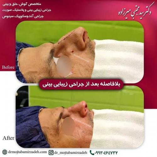 جراحی-بینی-یزد233