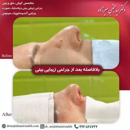 جراحی-بینی-یزد234