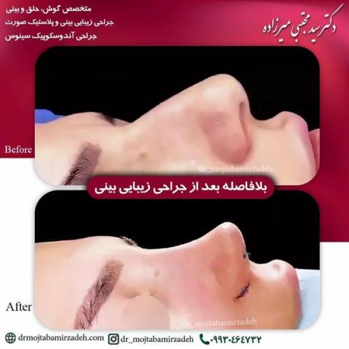 جراحی-بینی-یزد236