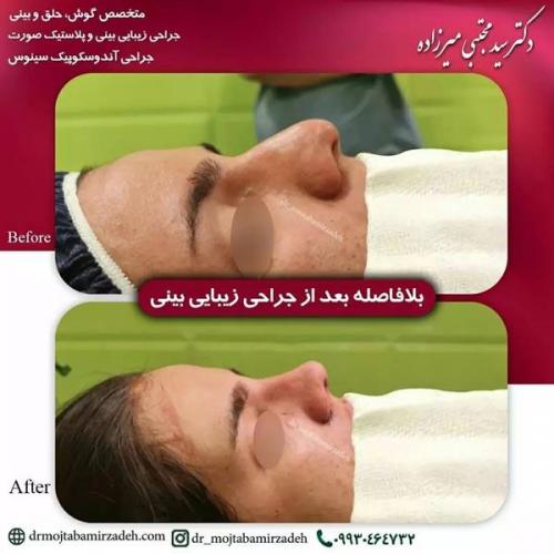 جراحی-بینی-یزد238