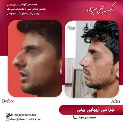 جراحی-بینی-یزد241