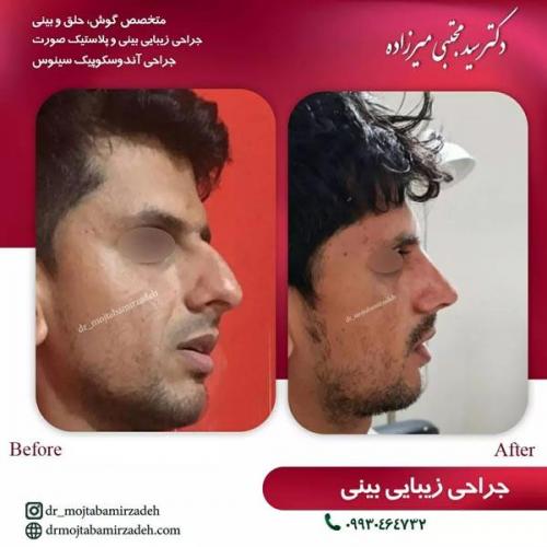جراحی-بینی-یزد242