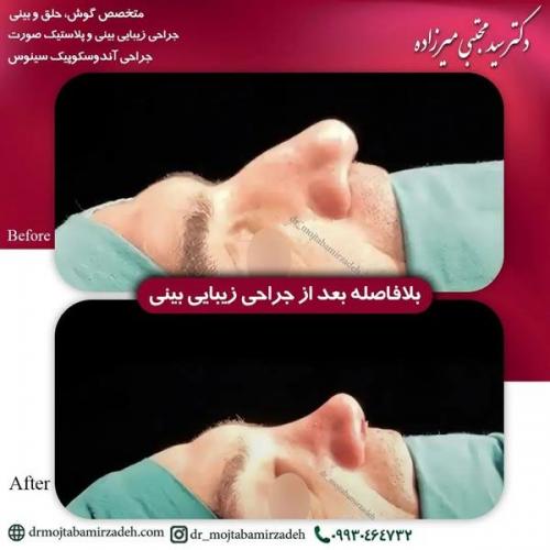 جراحی-بینی-یزد244