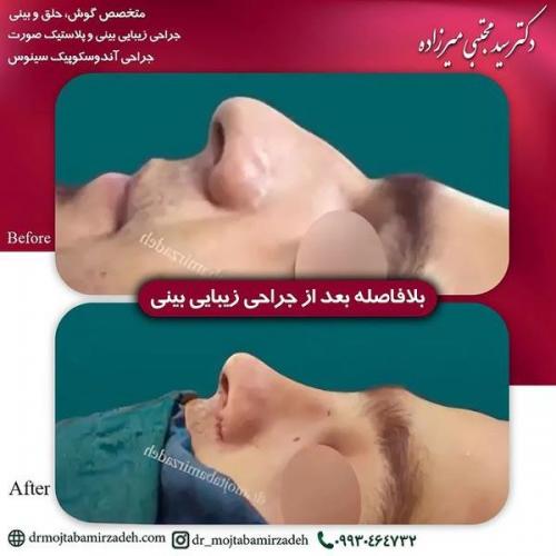 جراحی-بینی-یزد257