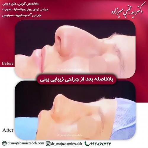 جراحی-بینی-یزد265