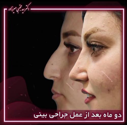 جراحی-بینی-یزد292