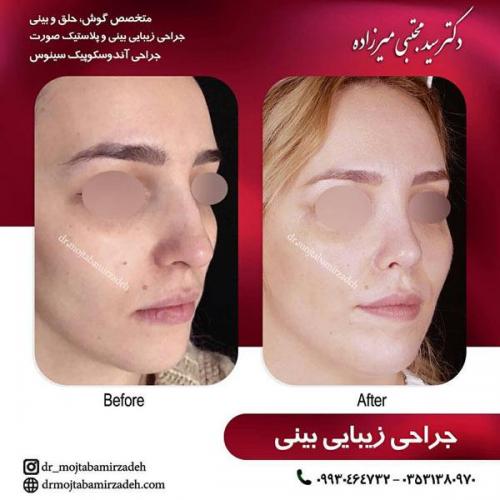 جراحی-بینی-یزد92