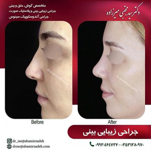 جراحی-بینی-یزد93