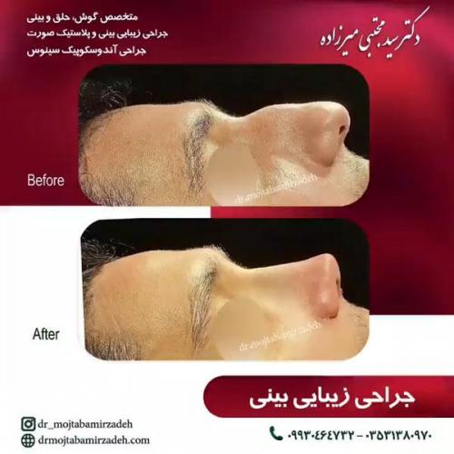 جراحی-بینی-یزد94