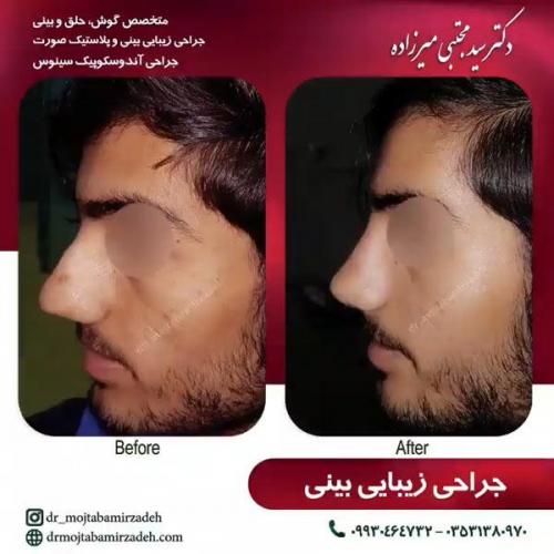 جراحی-بینی-یزد95