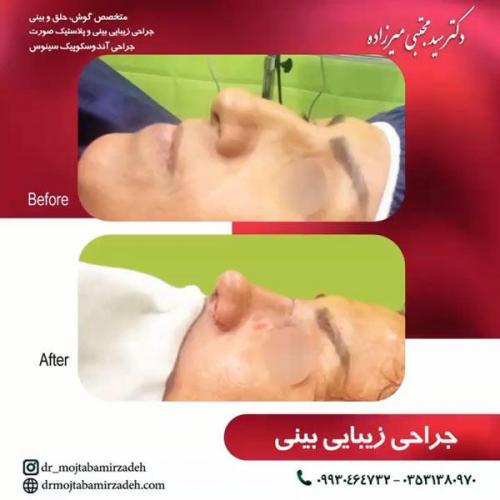 جراحی-بینی-یزد97