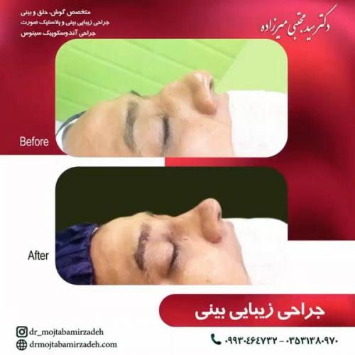 جراحی-بینی-یزد98