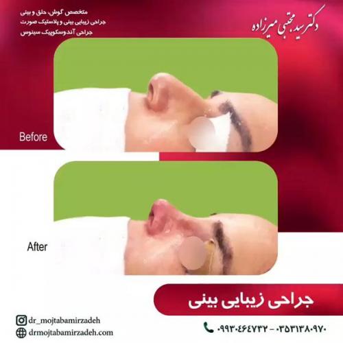 جراحی-بینی-یزد99